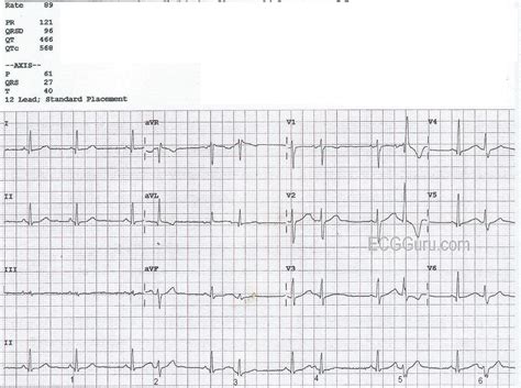 Bigeminal Rhythm With Aberrant Conduction | ECG Guru - Instructor Resources