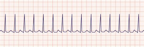 ECG INTERPRETATION FOR NCLEX: PART THREE - The Nurse Speak