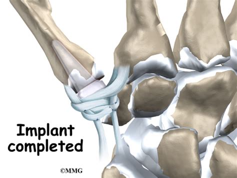 Artificial Joint Replacement of the Thumb - eOrthopod.com