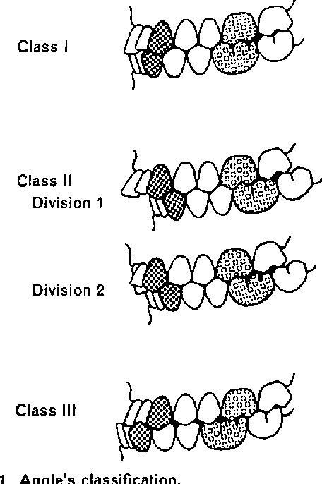 Angle's Classification of Occlusion - MEDizzy, class ii - plantecuador.com