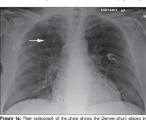 Figure 1 from Complications of Denver Shunt | Semantic Scholar