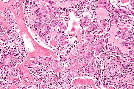 Medullary thyroid carcinoma - Libre Pathology