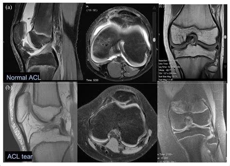 MRI of the knee. (a) Normal ACL images. (b) ACL tear. | Download ...