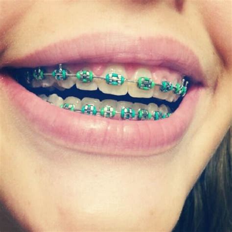 Pin by Neely Long on BRACES | Green braces, Braces colors, Teeth braces