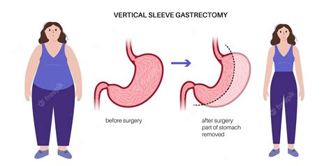 Vertical Banded Gastroplasty Before And After