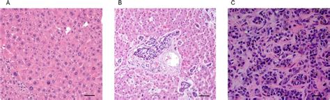 Histology of liver cancer development. A: Histological sections of... | Download Scientific Diagram