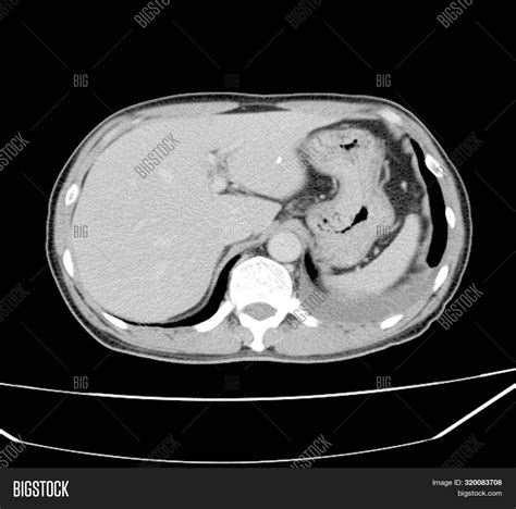 Pacemaker X-ray Image Image & Photo (Free Trial) | Bigstock