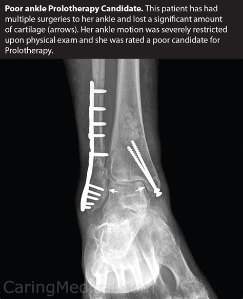 Fused Ankle Bones