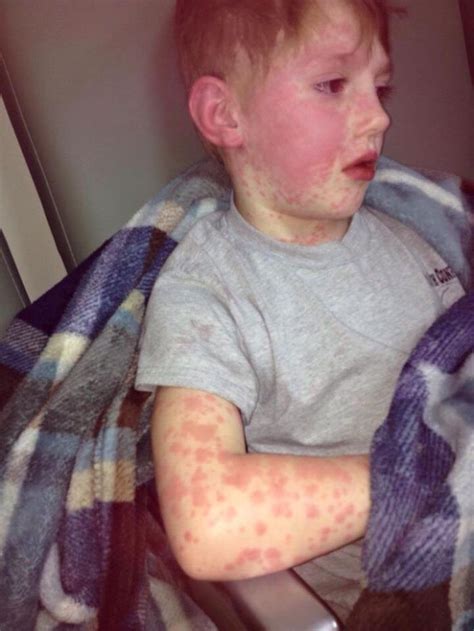 Child Complained Of Poison Oak But It Was Stevens Johnson Syndrome