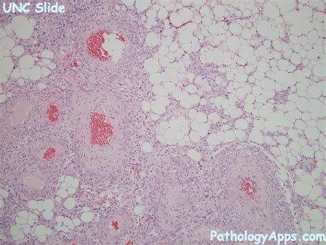 angiomyolipoma pathology