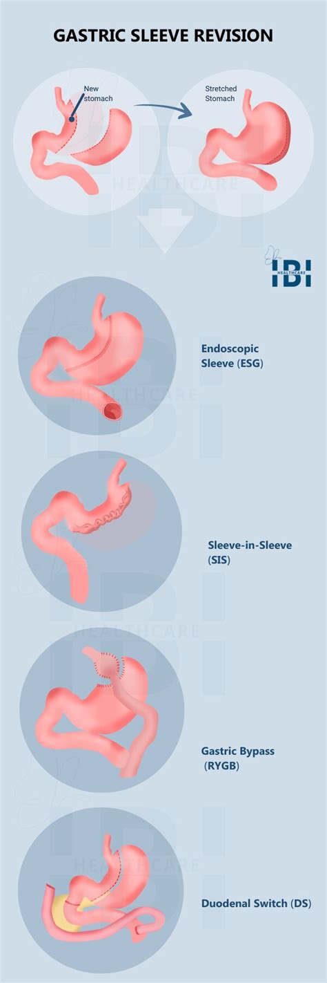 Gastric Bypass & Gastric Sleeve Revision - TORe & GSRe