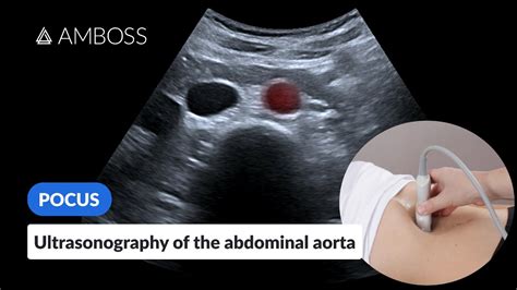 Point of Care Ultrasound of the Abdominal Aorta - AMBOSS Video - YouTube