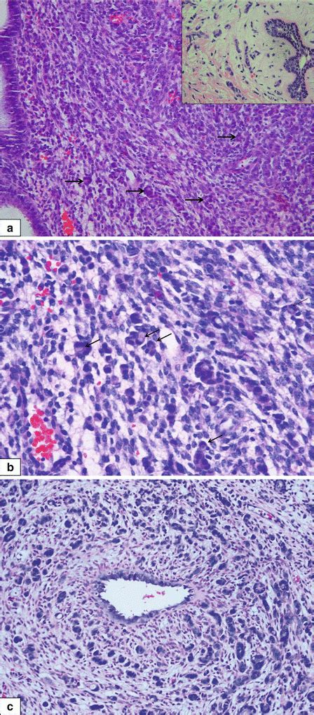 Lobular Lesions (Lobular Neoplasia, Invasive Lobular Carcinoma) | Basicmedical Key