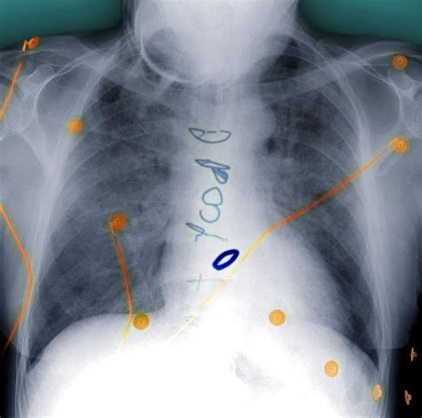 Heart Surgery, X-ray Photograph by Du Cane Medical Imaging Ltd - Pixels