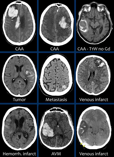 Intraparenchymal Hemorrhage Vs Subarachnoid Hemorrhage