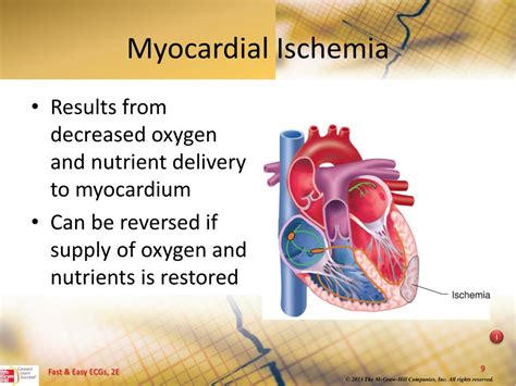 PPT - Myocardial Ischemia, Injury, and Infarction PowerPoint Presentation - ID:3701654