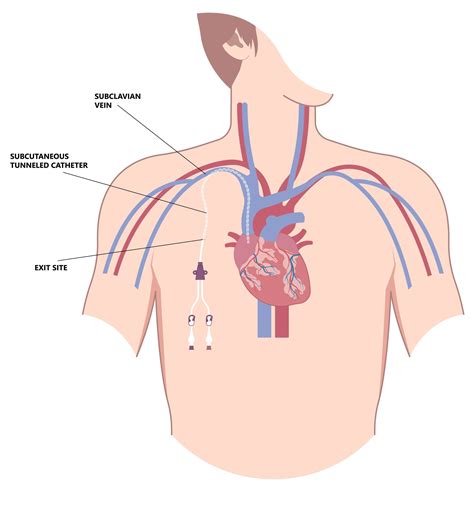 DIALYSIS CATHETER PLACEMENT – Elite Diagnostic