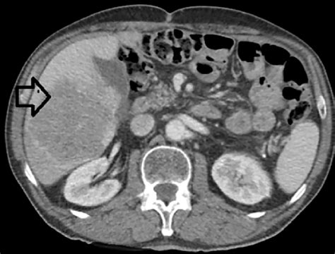 Resection of Large Metachronous Liver Metastasis with Gastric Origin ...