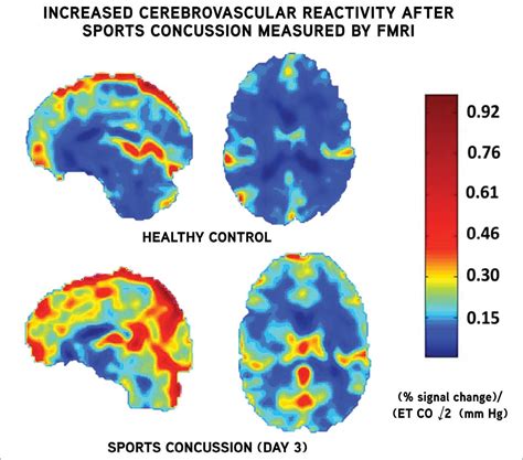 [DIAGRAM] Diagram Of Concussion Mri - MYDIAGRAM.ONLINE