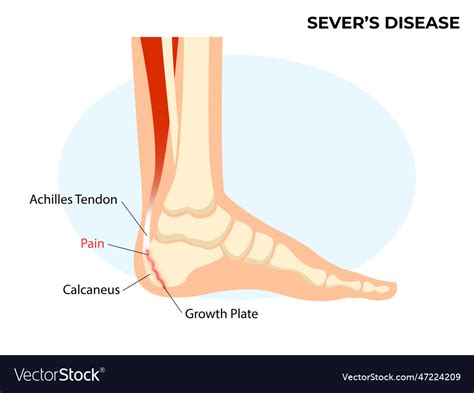 Severs disease calcaneal apophysitis ankle injury Vector Image