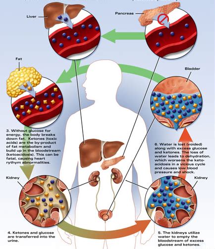 酮症酸中毒【多图】_39医疗图集-39健康网
