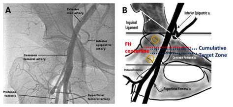 JCM | Free Full-Text | Vascular Complications in TAVR: Incidence, Clinical Impact, and Management