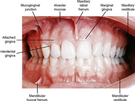 FIG. 1-2 View of vestibule. A change in color at the mucogingival junction is noted. The ...