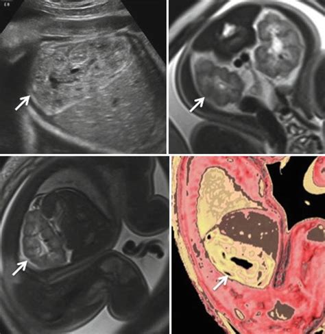 Prenatal Diagnosis of Beckwith-Wiedemann Syndrome Using 3D Ultrasound ...