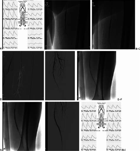 Superficial femoral artery (SFA) recanalization with self-expanding... | Download Scientific Diagram