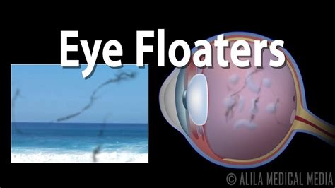 Do Eye Floaters Mean Brain Tumor? Top 6 Best Answers - Musicbykatie.com