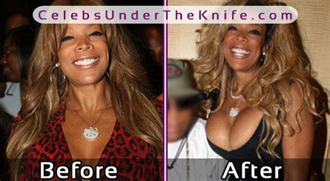 Wendy Williams' Boob Job! Take A Look At Her Before + After Photos