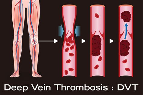 Deep Vein Thrombosis - Dr Toby Cohen