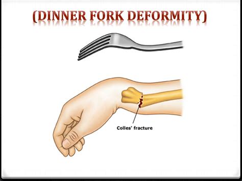 Dinner fork deformity : causes , symptoms & treatment