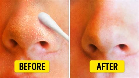 How to get rid of blackheads forever - Blackheads | Ventuneac