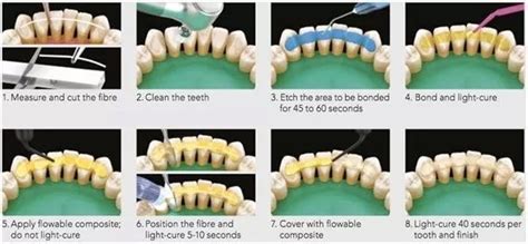 Splinting | FMS DENTAL HOSPITAL