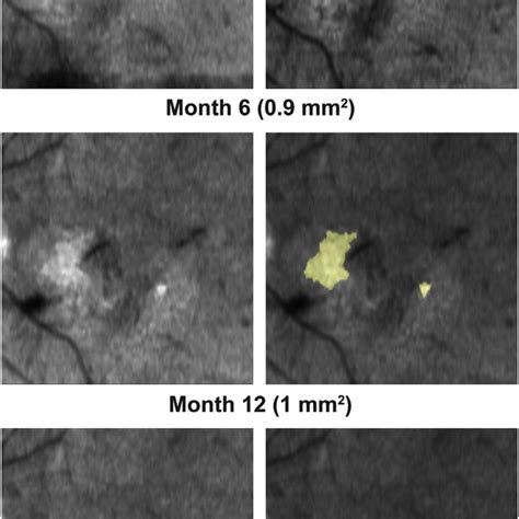 Images showing an example case of macular atrophy, with drawings on en ...