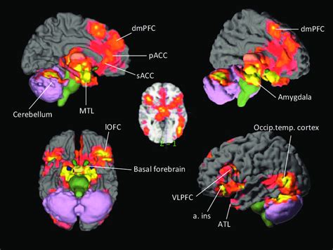 Meta-analytic findings of emotion. Brain areas with a consistent ...