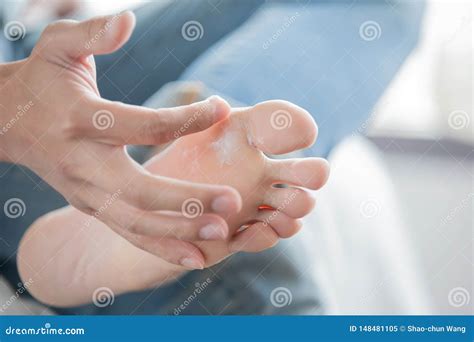 Applying Cream for Athletes Foot Stock Image - Image of infection ...