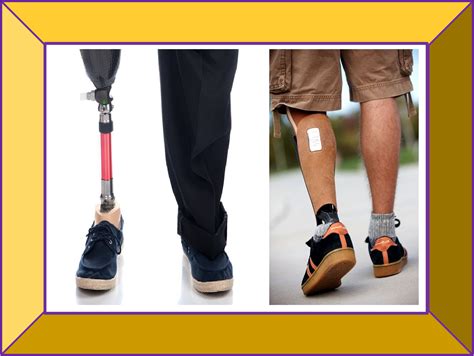 Prosthetics & Orthotics from My Care: Lower Limb Prosthesis