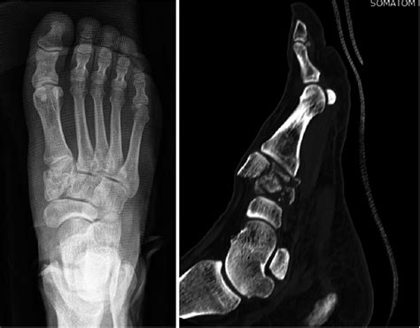 Cuneiform Bone Fracture