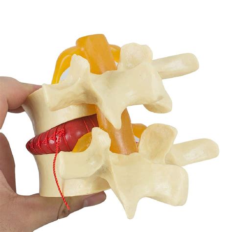 Buy Human Model, 11 Lumbar disc herniation Demonstration Model - Human Spine Model - Anatomical ...