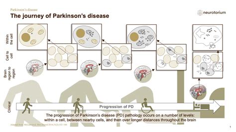 Parkinsons Disease - Course, Natural History and Prognosis - Neurotorium