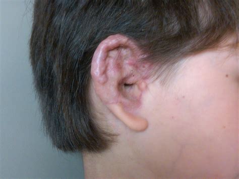 Microtia and Aural Atresia - Our Experience: Three and a Half + Post Microtia Repair