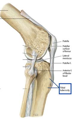 Tibial Tubercle Osteotomy Melbourne VIC