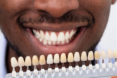 Dental Veneers vs. Crowns: What's the Difference? - Allred Dental