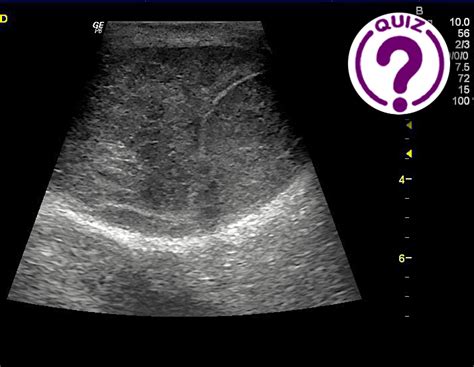 Case of the Month July 2021- Palpable inguinal lymph nodes – WFUMB