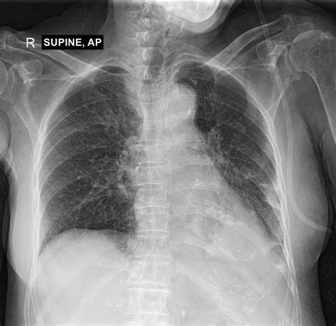 How Quickly Does Aspiration Pneumonia Develop