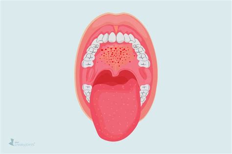 COVID-19 Might Cause Mouth Lesions, New Study Suggests