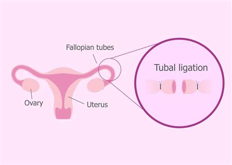 Tubal Ligation Side Effects