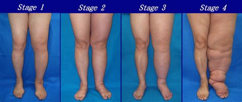 Signs & Symptoms of Lymphedema - Pain & Swelling Solutions